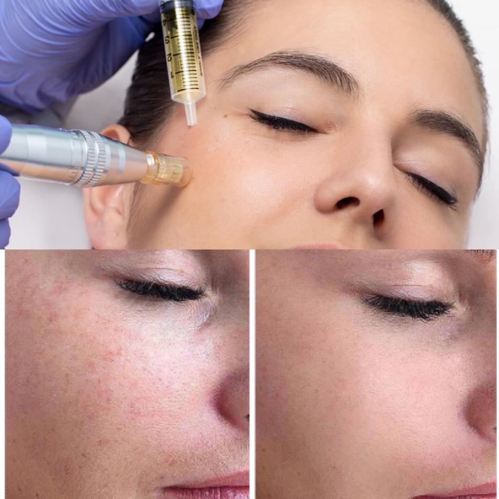 Microneedling